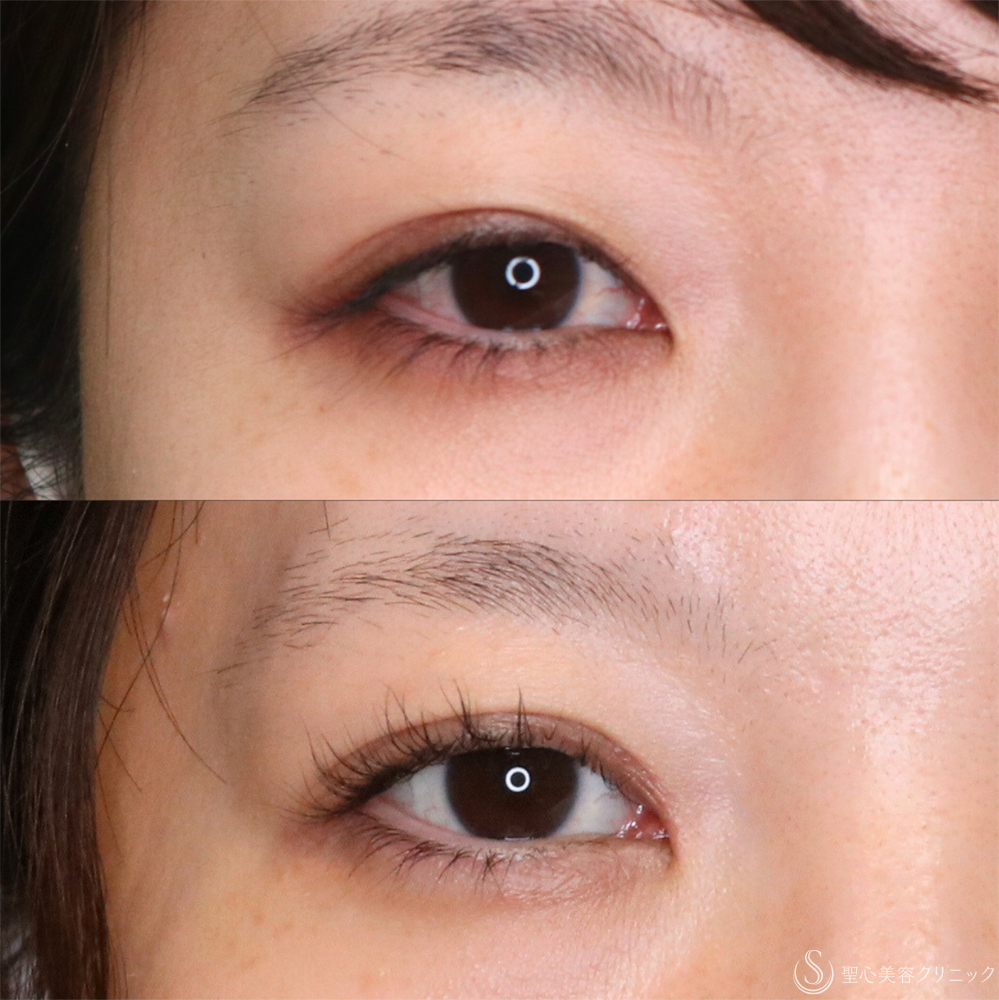 【30代女性・理想の平行二重に】目頭切開/目上切開（1ヶ月後） After 名古屋・目頭切開