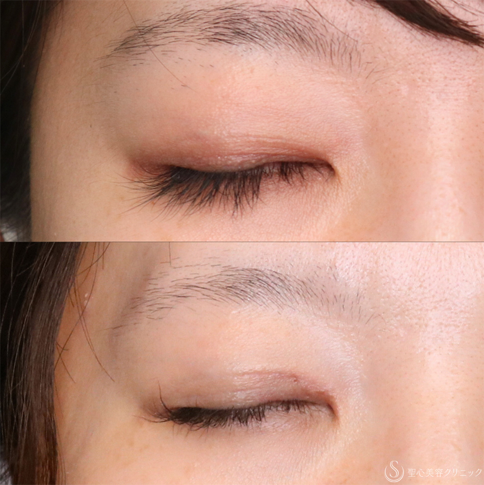 【30代女性・理想の平行二重に】目頭切開/目上切開（1ヶ月後） After 名古屋・目頭切開