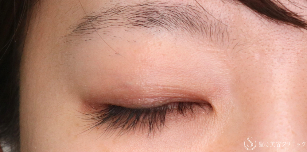 【30代女性・理想の平行二重に】目頭切開/目上切開（1ヶ月後） Before 名古屋・目頭切開