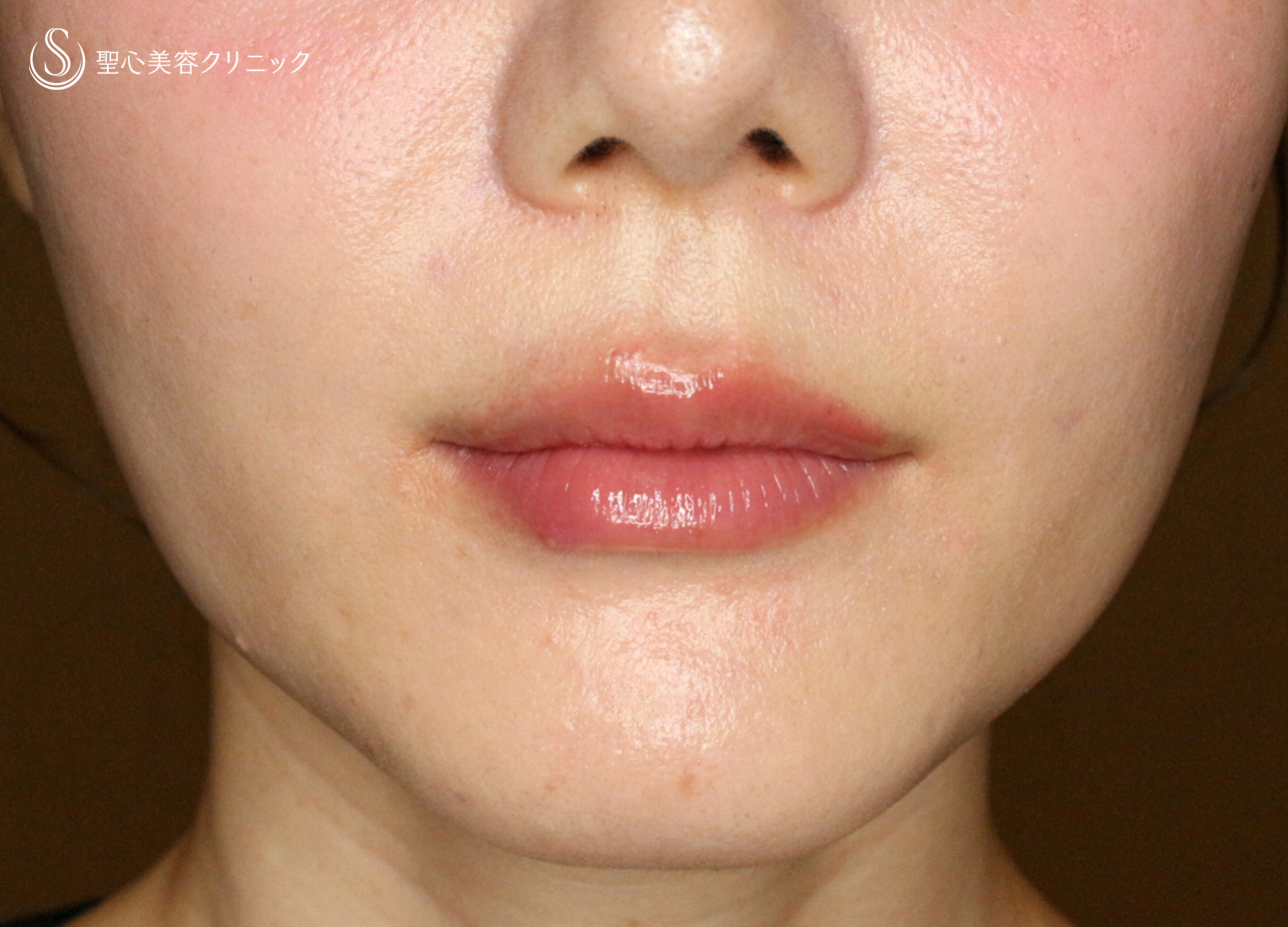 【30代女性・スマイルリップ注入法】ヒアルロン酸レスチレンリド（注入直後〜1ヶ月後） After 