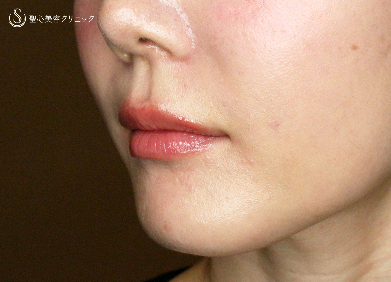 【30代女性・スマイルリップ注入法】ヒアルロン酸レスチレンリド（注入直後〜1ヶ月後） After 