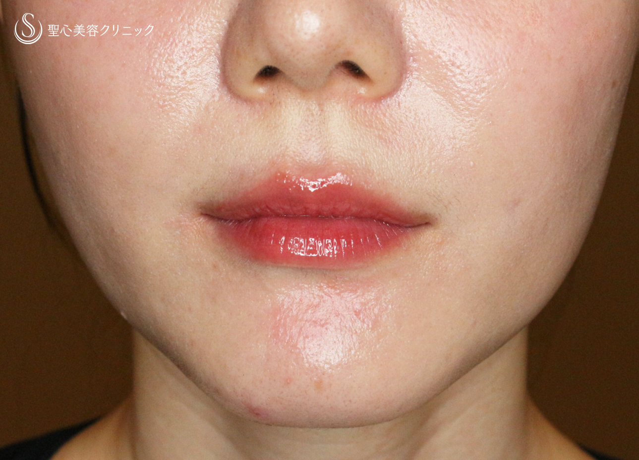 【30代女性・スマイルリップ注入法】ヒアルロン酸レスチレンリド（注入直後〜1ヶ月後） After 