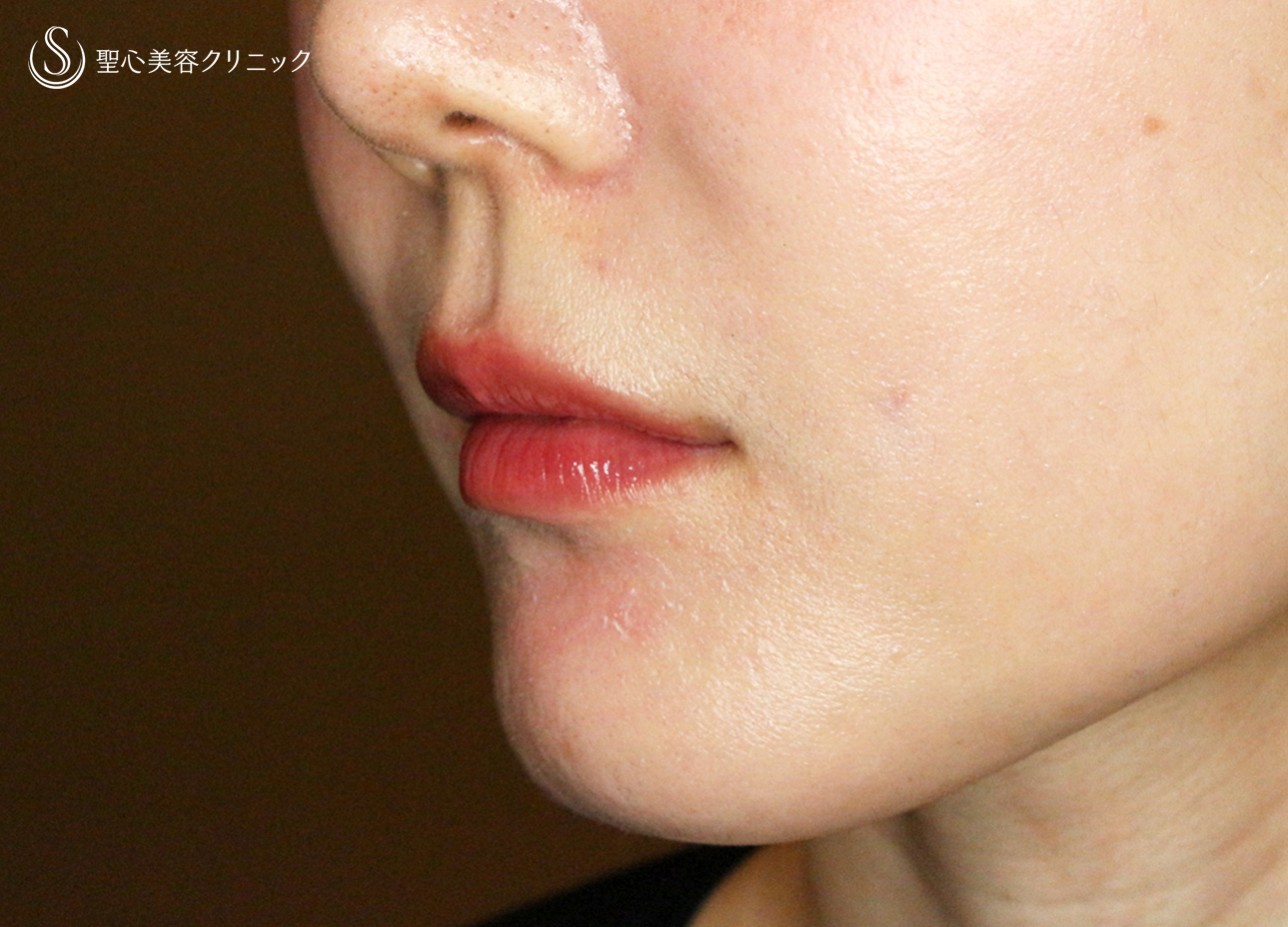 【30代女性・スマイルリップ注入法】ヒアルロン酸レスチレンリド（注入直後〜1ヶ月後） After 