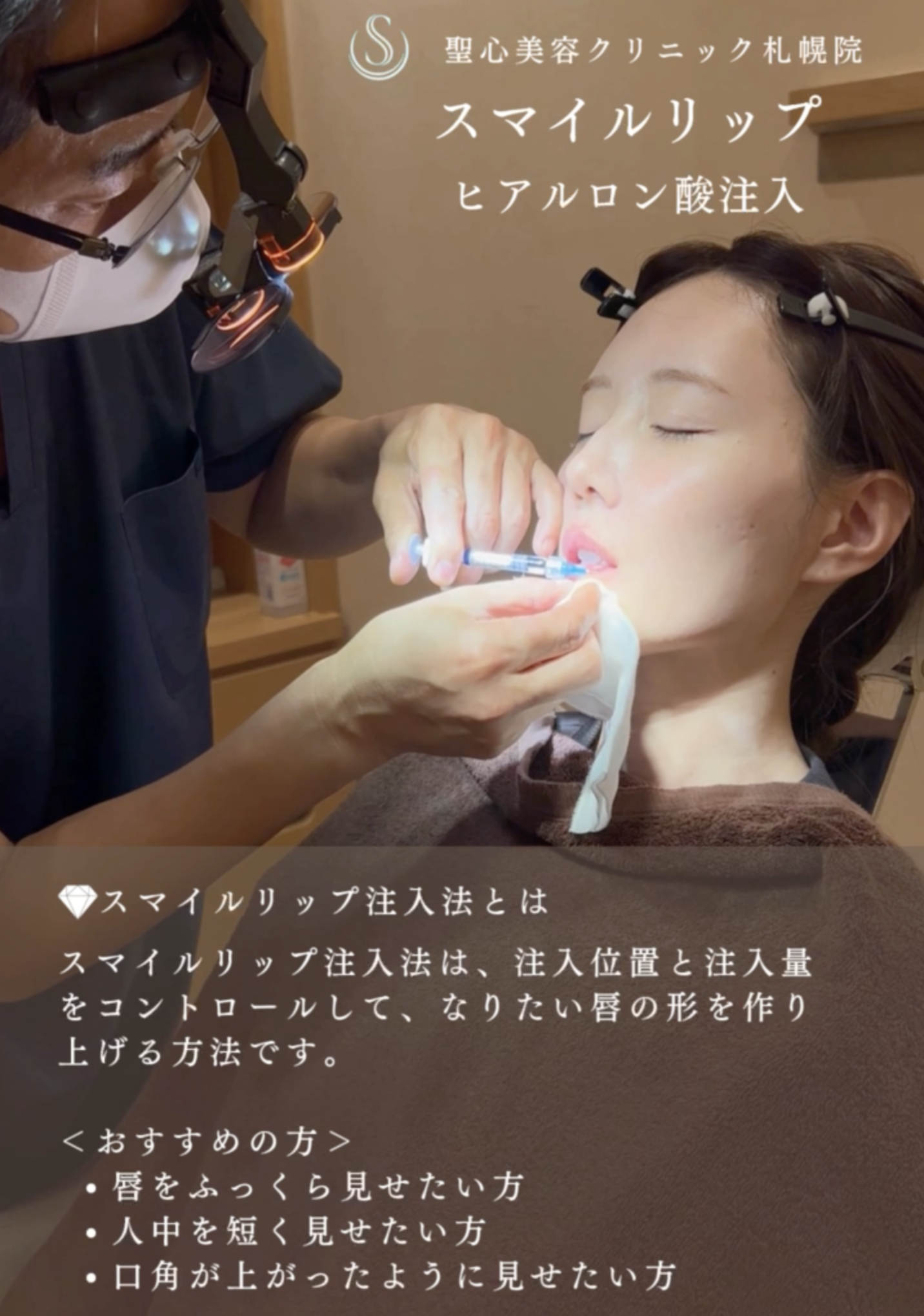 【30代女性・スマイルリップ注入法】ヒアルロン酸レスチレンリド（注入直後〜1ヶ月後） After 