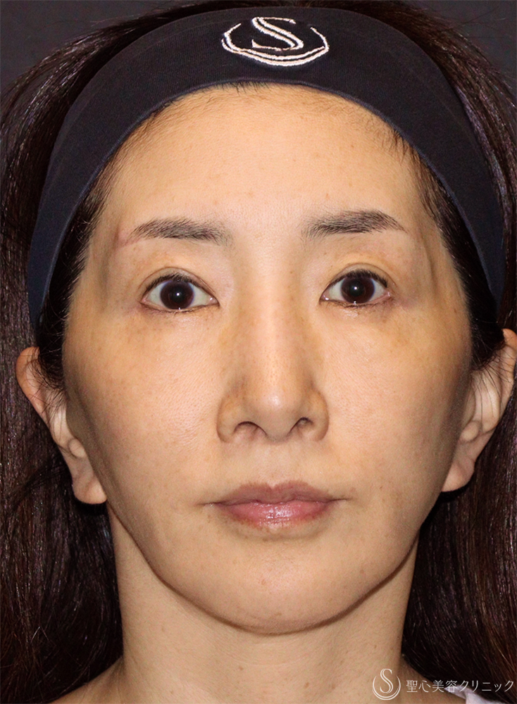 【50代女性・若々しく優しい印象に】トータルフェイシャルトリートメント＋ ボトックスリフト（1ヶ月後） Before 