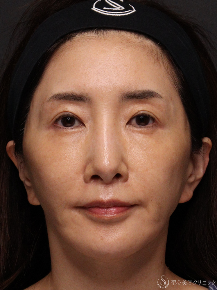 【50代女性・若々しく優しい印象に】トータルフェイシャルトリートメント＋ ボトックスリフト（1ヶ月後） After 