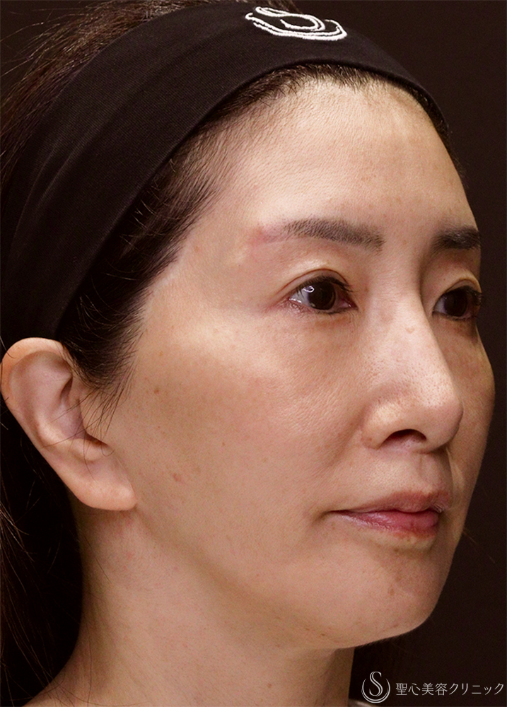 【50代女性・若々しく優しい印象に】トータルフェイシャルトリートメント＋ ボトックスリフト（1ヶ月後） Before 