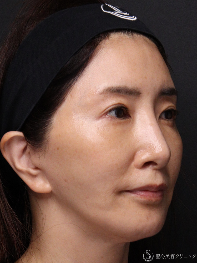 【50代女性・若々しく優しい印象に】トータルフェイシャルトリートメント＋ ボトックスリフト（1ヶ月後） After 