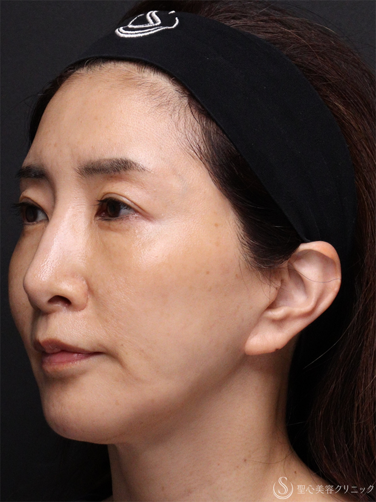 【50代女性・若々しく優しい印象に】トータルフェイシャルトリートメント＋ ボトックスリフト（1ヶ月後） After 