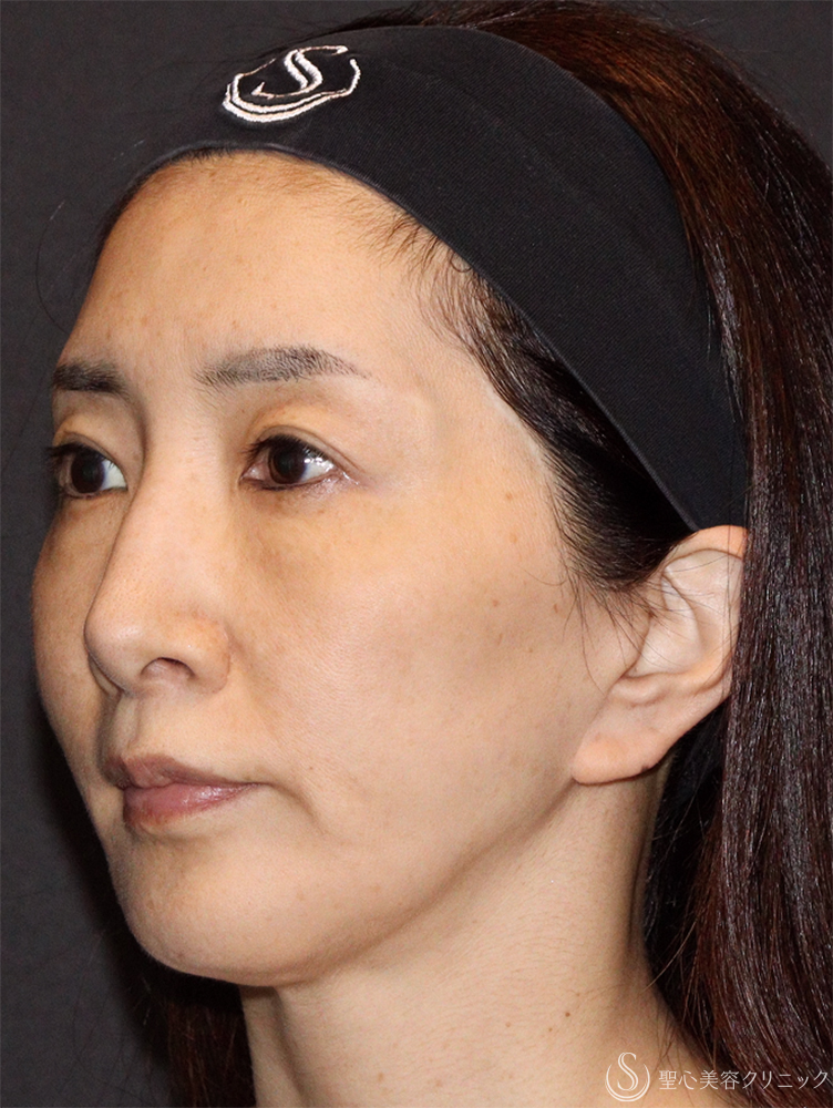 【50代女性・若々しく優しい印象に】トータルフェイシャルトリートメント＋ ボトックスリフト（1ヶ月後） Before 