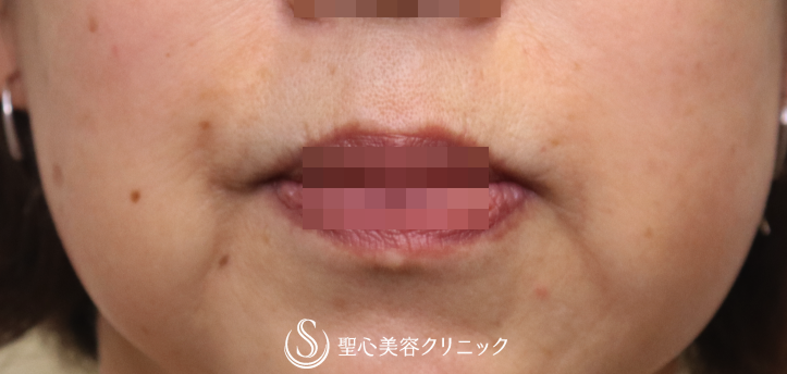 【60代女性・ほうれい線〜マリオネットラインの若返り】プレミアムPRP皮膚再生療法（3ヶ月） After 