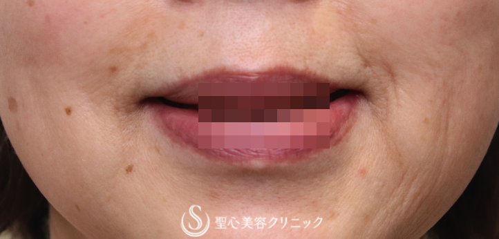 【60代女性・ほうれい線〜マリオネットラインの若返り】プレミアムPRP皮膚再生療法（3ヶ月） After 