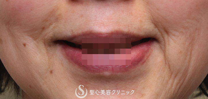 【60代女性・ほうれい線〜マリオネットラインの若返り】プレミアムPRP皮膚再生療法（3ヶ月） Before 