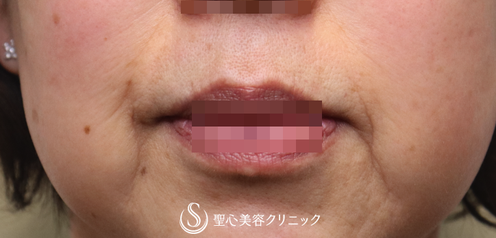 【60代女性・ほうれい線〜マリオネットラインの若返り】プレミアムPRP皮膚再生療法（3ヶ月） Before 