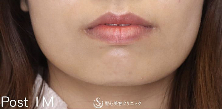 【20代女性・上品な唇に】口唇縮小術（1ヶ月後） After 