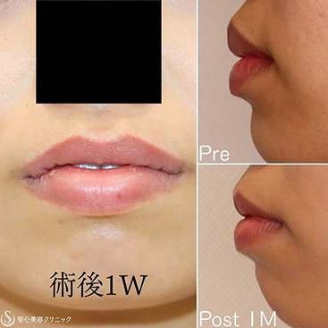 【20代女性・上品な唇に】口唇縮小術（1ヶ月後） After 