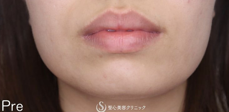 【20代女性・上品な唇に】口唇縮小術（1ヶ月後） Before 