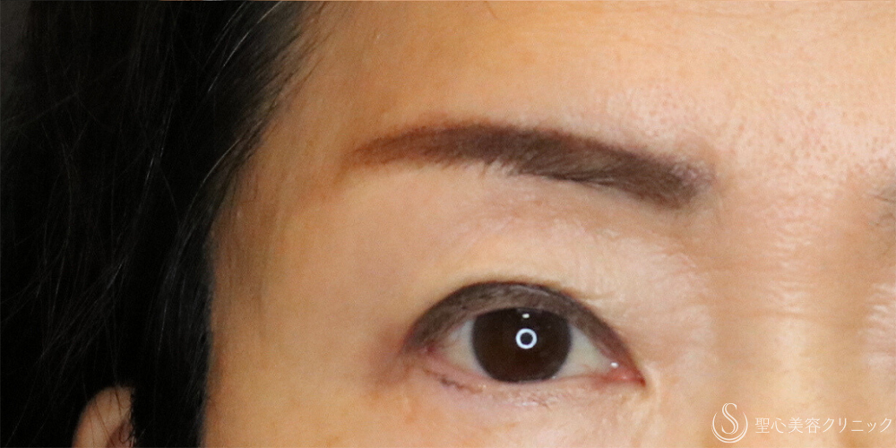 【60代女性・お目元のアンチエイジングでまぶたスッキリ】眉下切開法（眉下リフト）（2年5ヶ月後） After 