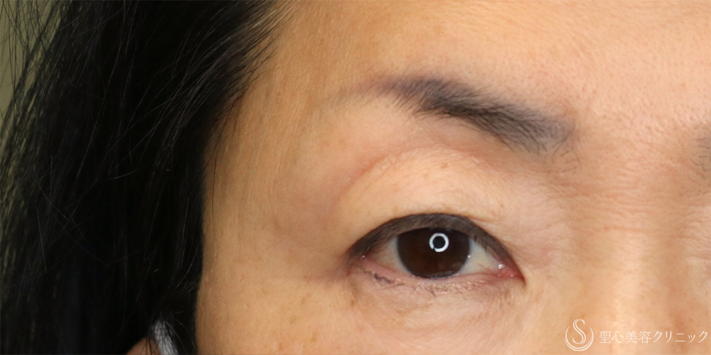 【60代女性・お目元のアンチエイジングでまぶたスッキリ】眉下切開法（眉下リフト）（2年5ヶ月後） Before 