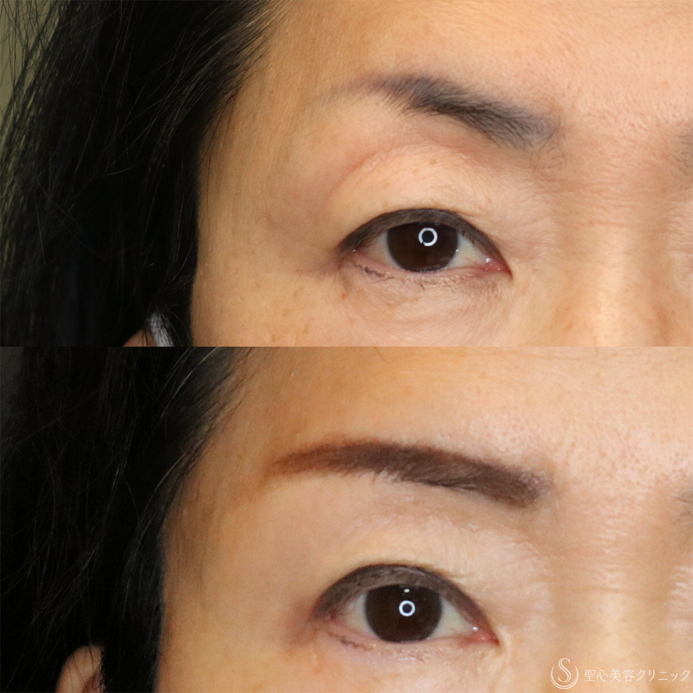 【60代女性・お目元のアンチエイジングでまぶたスッキリ】眉下切開法（眉下リフト）（2年5ヶ月後） After 