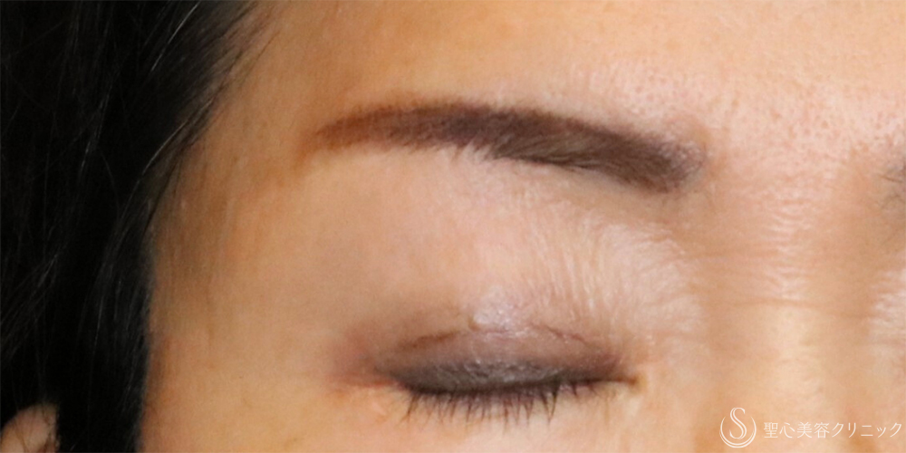 【60代女性・お目元のアンチエイジングでまぶたスッキリ】眉下切開法（眉下リフト）（2年5ヶ月後） After 