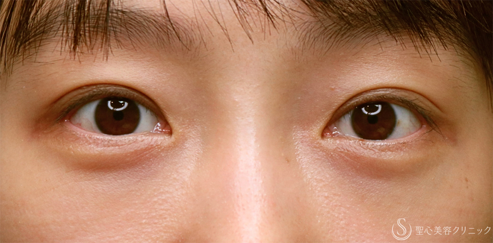 【30代女性・目の下のクマを注射で改善】プレミアムPRP皮膚再生療法（1年後） After 名古屋・クマ取り