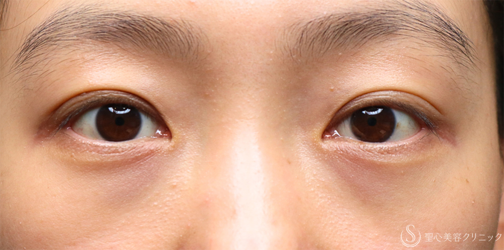 【30代女性・目の下のクマを注射で改善】プレミアムPRP皮膚再生療法（1年後） Before 名古屋・クマ取り
