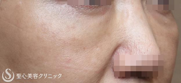 【50代女性・目の下のたるみを注入治療で改善】プレミアムPRP皮膚再生療法（6ヶ月） After 