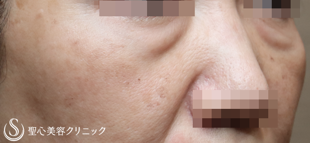 【50代女性・目の下のたるみを注入治療で改善】プレミアムPRP皮膚再生療法（6ヶ月） Before 