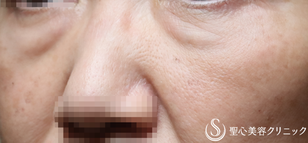 【50代女性・目の下のたるみを注入治療で改善】プレミアムPRP皮膚再生療法（6ヶ月） Before 