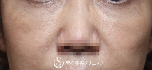 【50代女性・目の下のたるみを注入治療で改善】プレミアムPRP皮膚再生療法（6ヶ月） After 
