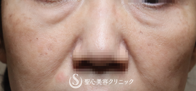 【50代女性・目の下のたるみを注入治療で改善】プレミアムPRP皮膚再生療法（6ヶ月） Before 