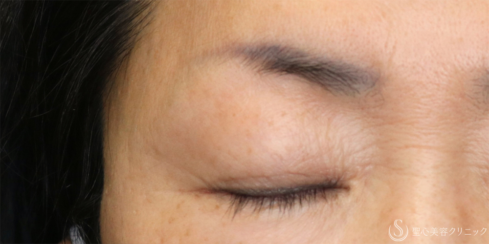 【60代女性・お目元のアンチエイジングでまぶたスッキリ】眉下切開法（眉下リフト）（2年5ヶ月後） Before 