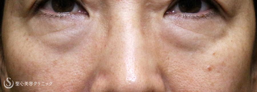 【50代女性・目の下のクマ劇的な変化】表ハムラ+α法「Ver.3」 単独（術直後〜3ヶ月後） Before 