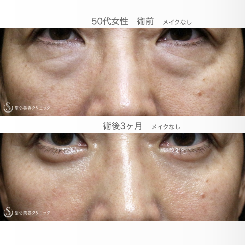 【50代女性・目の下のクマ劇的な変化】表ハムラ+α法「Ver.3」 単独（術直後〜3ヶ月後） After 