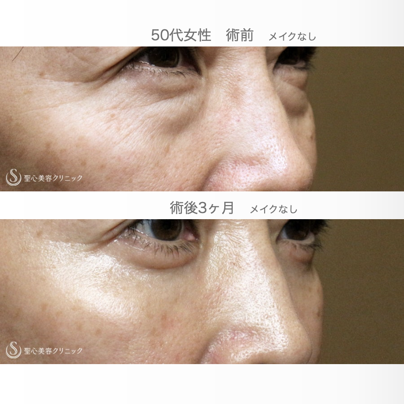 【50代女性・目の下のクマ劇的な変化】表ハムラ+α法「Ver.3」 単独（術直後〜3ヶ月後） After 