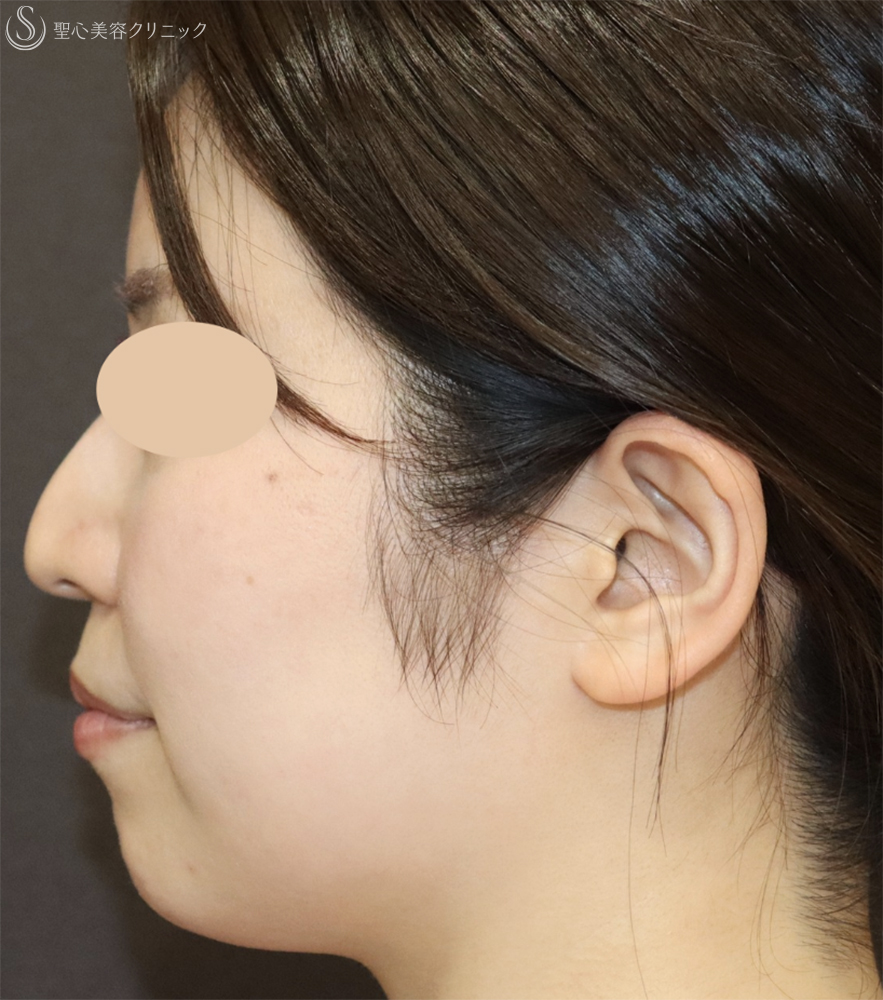 【30代女性・口元の印象をすっきり】顎のヒアルロン酸注入（注入直後） Before 