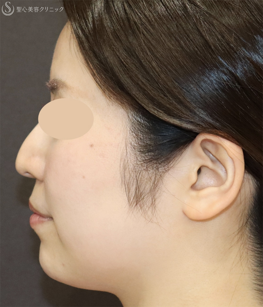 【30代女性・口元の印象をすっきり】顎のヒアルロン酸注入（注入直後） After 