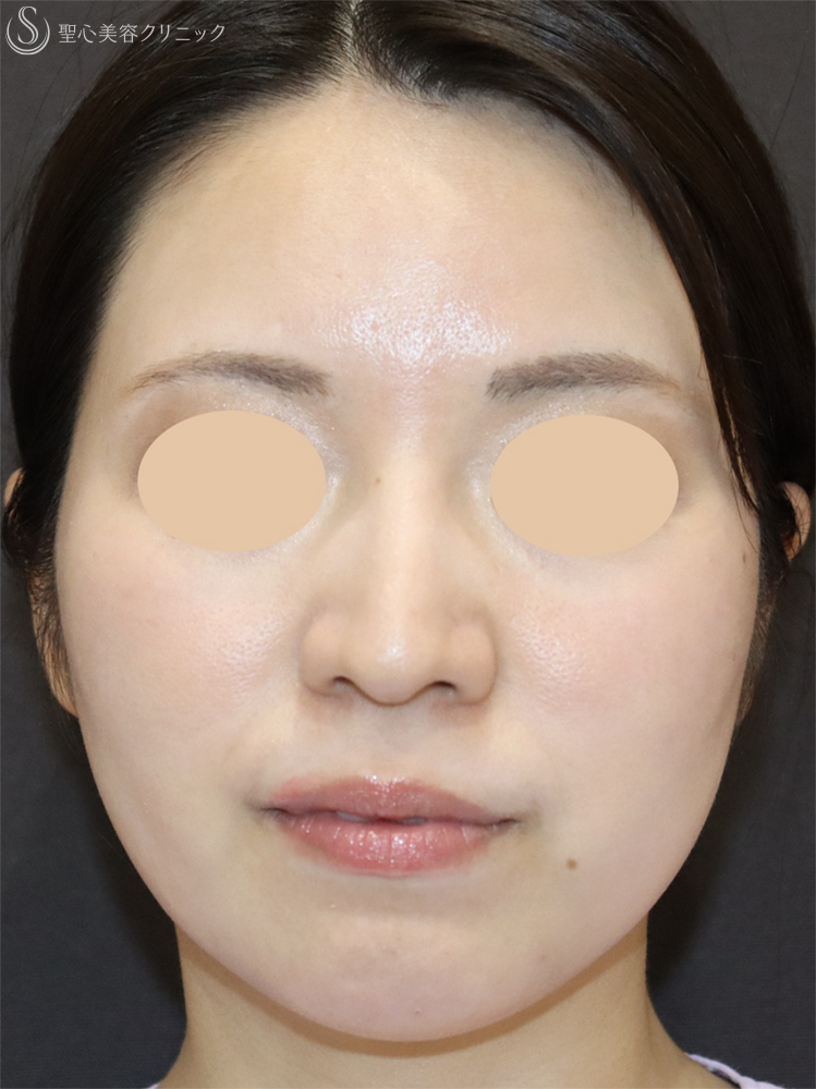 【30代女性・口元の印象をすっきり】顎のヒアルロン酸注入（注入直後） Before 