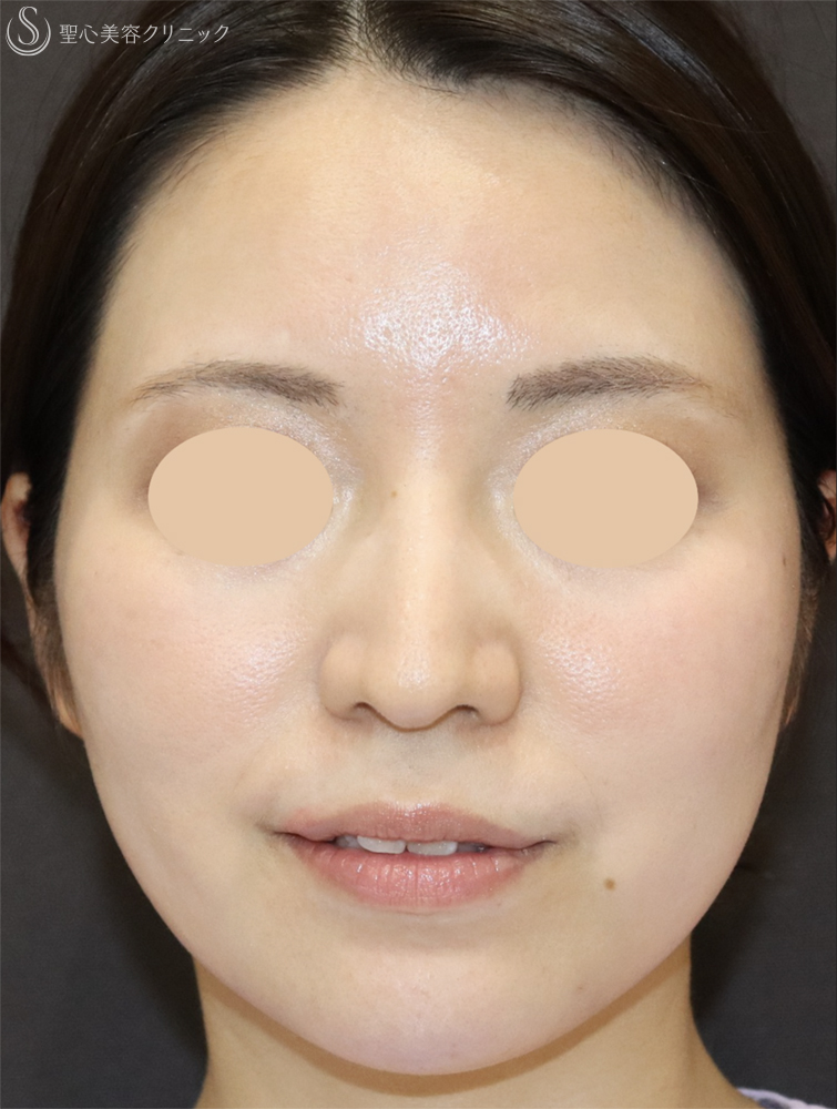 【30代女性・口元の印象をすっきり】顎のヒアルロン酸注入（注入直後） After 