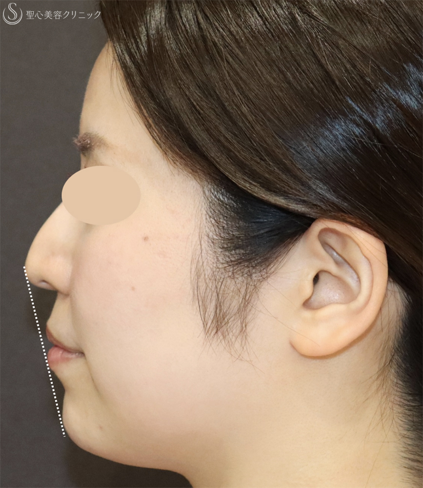 【30代女性・口元の印象をすっきり】顎のヒアルロン酸注入（注入直後） After 