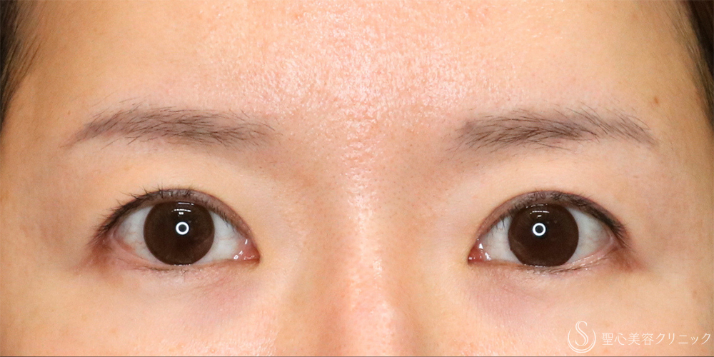 【30代女性・目の上を自然にすっきり】重瞼線部分開法（目の上のタルミ取り）（1週間後） Before 