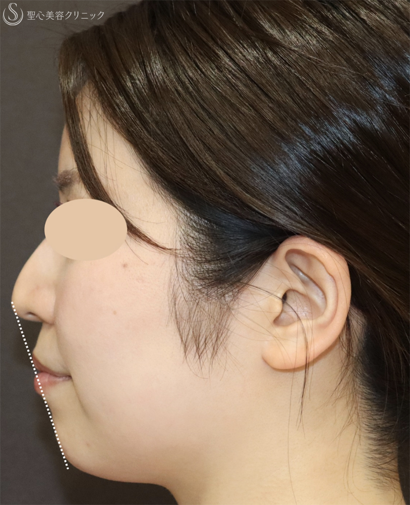 【30代女性・口元の印象をすっきり】顎のヒアルロン酸注入（注入直後） Before 