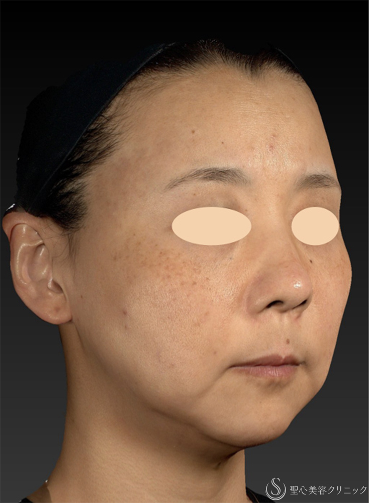 【40代女性・糸リフト長期経過3ヶ月後の3D解析】糸リフト（PDOスレッドリフト）（3ヶ月後） Before 