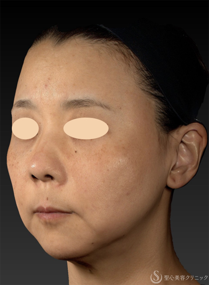 【40代女性・糸リフト長期経過3ヶ月後の3D解析】糸リフト（PDOスレッドリフト）（3ヶ月後） Before 