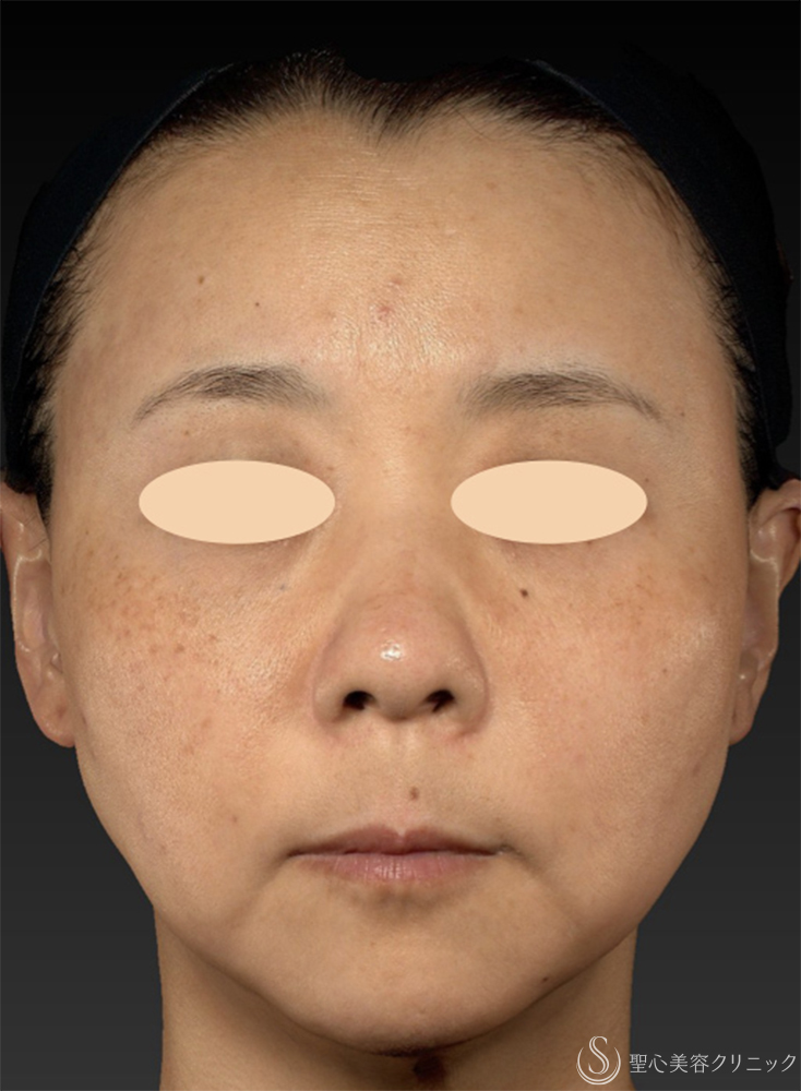 【40代女性・糸リフト長期経過3ヶ月後の3D解析】糸リフト（PDOスレッドリフト）（3ヶ月後） Before 