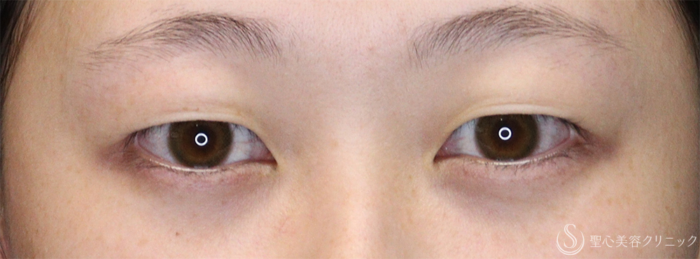 【20代女性・目力のある自然な二重に】二重術（埋没法）：マイクロメソッド+α（10日後） Before 