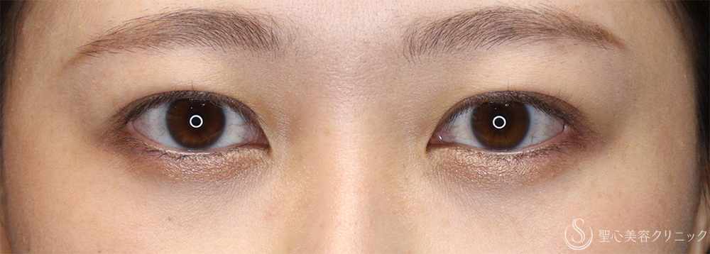 【20代女性・目力のある自然な二重に】二重術（埋没法）：マイクロメソッド+α（10日後） After 