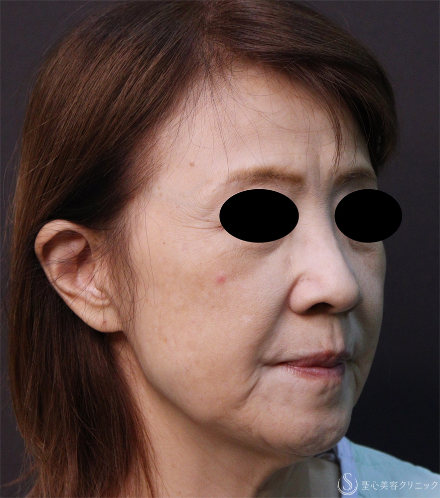 【60代女性・頬のたるみ】フェイスリフト（1ヶ月後） Before 