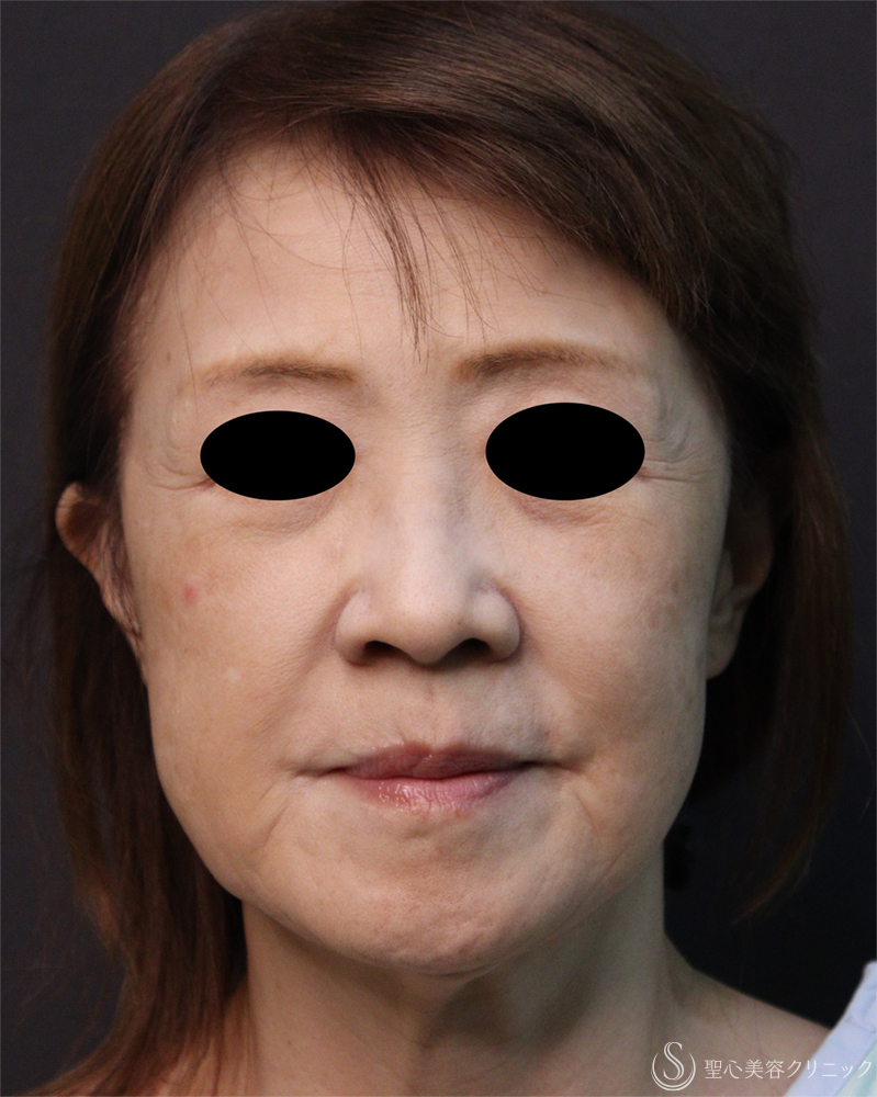 【60代女性・頬のたるみ】フェイスリフト（1ヶ月後） Before 